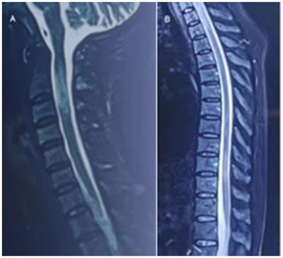 A case report of AQP4-IgG-seropositive refractory neuromyelitis optica spectrum disorder patient with Sjögren’s syndrome and pancytopenia treated with inebilizumab